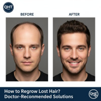 Advanced Hair Transplant in Hyderabad – QHT Clinic