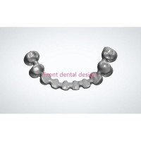 Dental Bridge Coping Design27