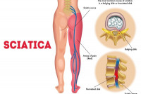 Best Homeopathic Medicine for Sciatica Nerve Pain - Doctor Bhargava