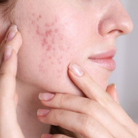 Acne scar in islamabad Pakistan