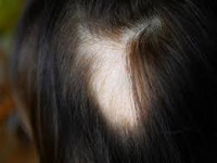 Alopecia Areata Treatment in Islamabad