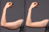 Arm Lift Surgery in dubai