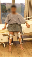 Best Limb Lengthening in India | Safe Height Increase Surgery