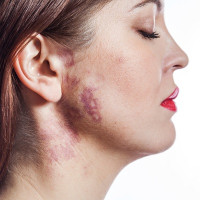 Bithmark removal in Islamabad