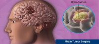 Cost of Brain Tumor Surgery India