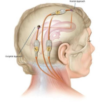 Hydrocephalus Surgery in India for Ethiopian Patients