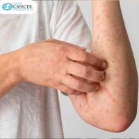 Skin Cancer Treatment in India