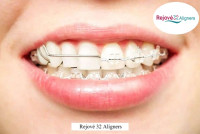 Affordable Clear Aligners Cost in India