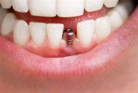 Dental Implants in Islamabad