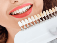 E-max Veneers in Dubai