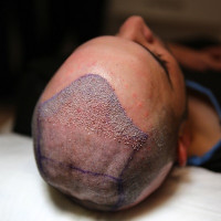 Hair Transplant