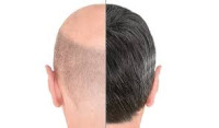 زراعة الشعر في دبي