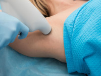 Laser Hyperhidrosis Treatment in Dubai