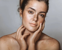 Best melasma treatment in Islamabad
