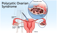 Best PCOS specialist in NYC