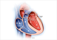 Pacemaker Implantation Surgery In India