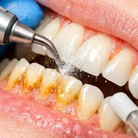 Teeth Scaling in islamabad