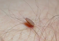 Treatment of Skin Tags for Smooth and Healthy Skin