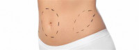 Tummy Tuck in Islamabad