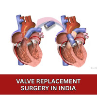 Affordable Valve Replacement Surgery