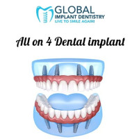 All-on-4 Dental Implants for Total Smile Renewal - Global Implant Dentistry