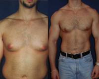Gynecomastia surgery in Lahore