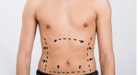 Liposuction in Lahore