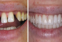 Dental Crown Experts Islamabad