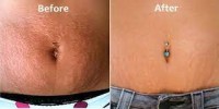 Stretch Mark Removal Treatment