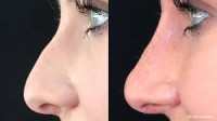 Nonsurgical Rhinoplasty in Islamabad