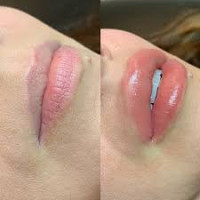 Lip Fillers Treatment In Islamabad