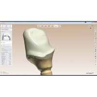 Dental Crown Coping Design8