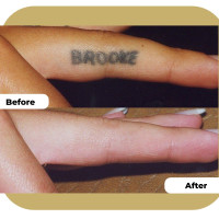 Laser Tattoo Removal