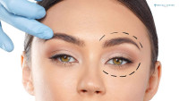 Best Eyelid Surgery in Islamabad – Safe Blepharoplasty by Experts