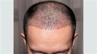 Hair Transplant in Islamabad