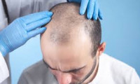 Hair Implants