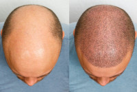 Hair transplant in Islamabad