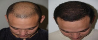 Hair transplant in Islamabad