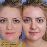 Microneedling in Islamabad