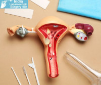 Ovarian Cancer Surgery Cost in India