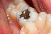 Get to know the major disadvantages of non-certified zirconia crowns.