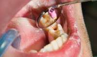 Root canal treatment in Islamabad