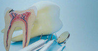 Root Canal Treatment in Islamabad