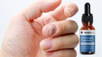 WellaNail: The Ultimate Nail Fungus Treatment That Works