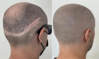 Scalp Micropigmentation Hair Density