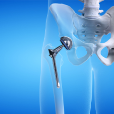 Hip arthroscopy in Mumbai - Pranjal Kodkani