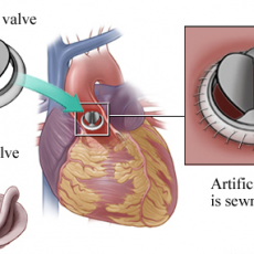 Famous Heart Valve Specialist in India