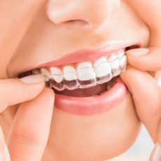 Dental Braces in Islamabad