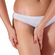 Stretch Mark Removal in Islamabad